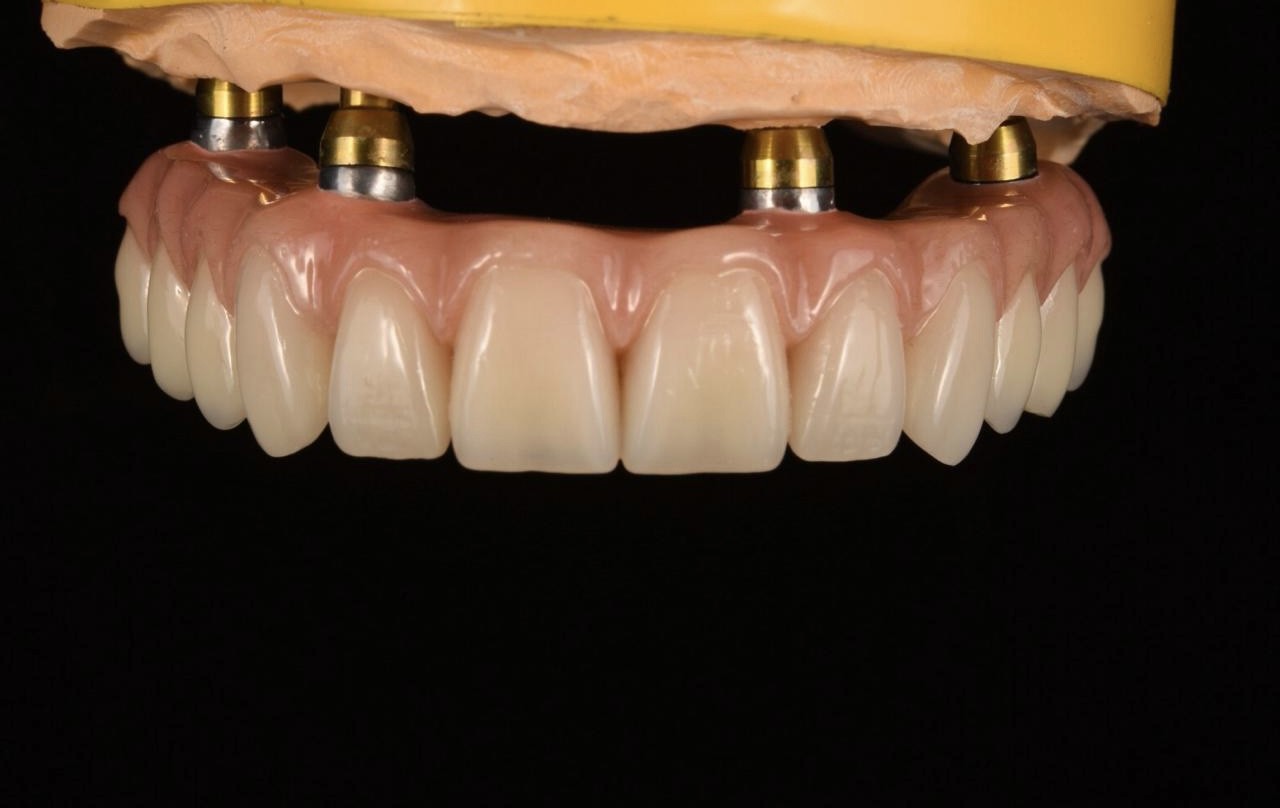 Имплантация зубов ALL-ON-6