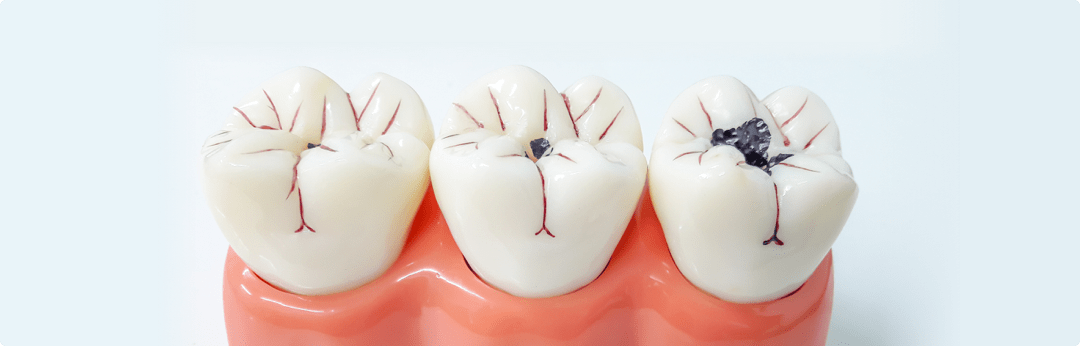 Острая зубная боль. Что делать, если сильно болит зуб?
