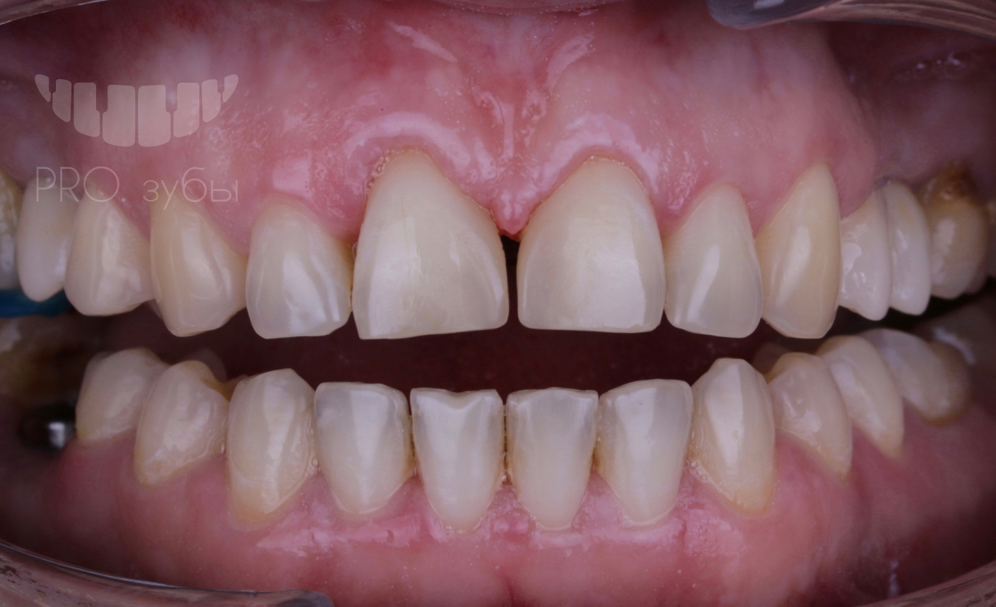 Реставрация фронтальной группы зубов