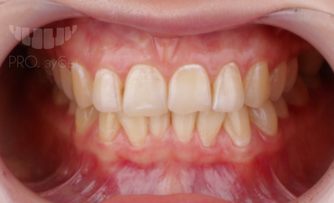 Отбеливание зубов ZOOM 4 12
