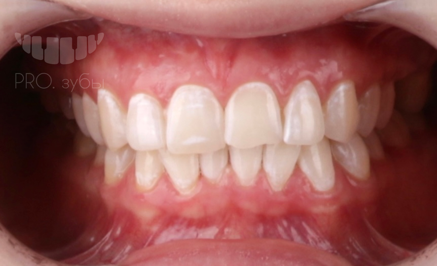 Отбеливание зубов ZOOM 4 12