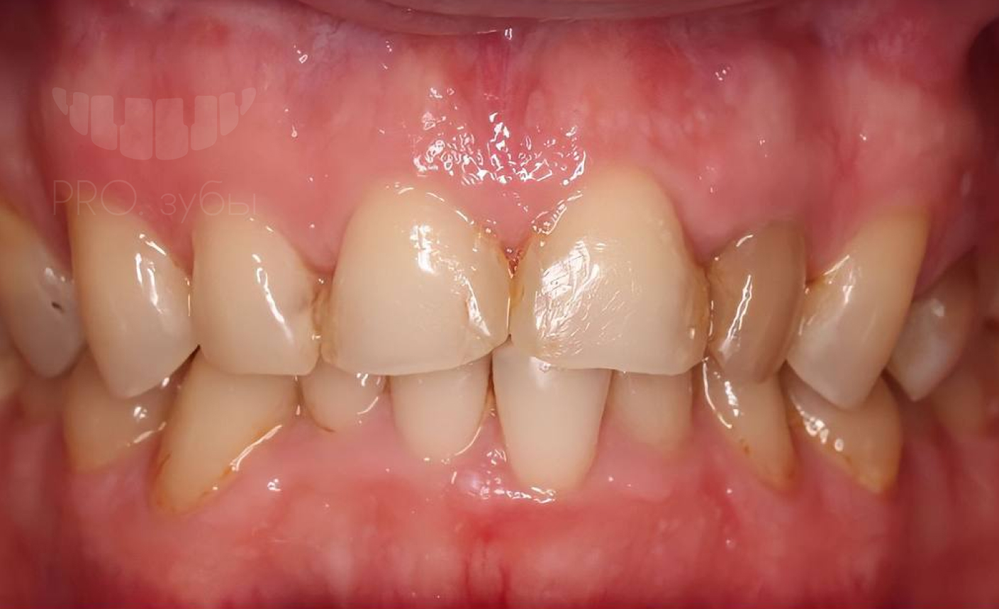 Внутриканальное отбеливание зуба. Боковой резец