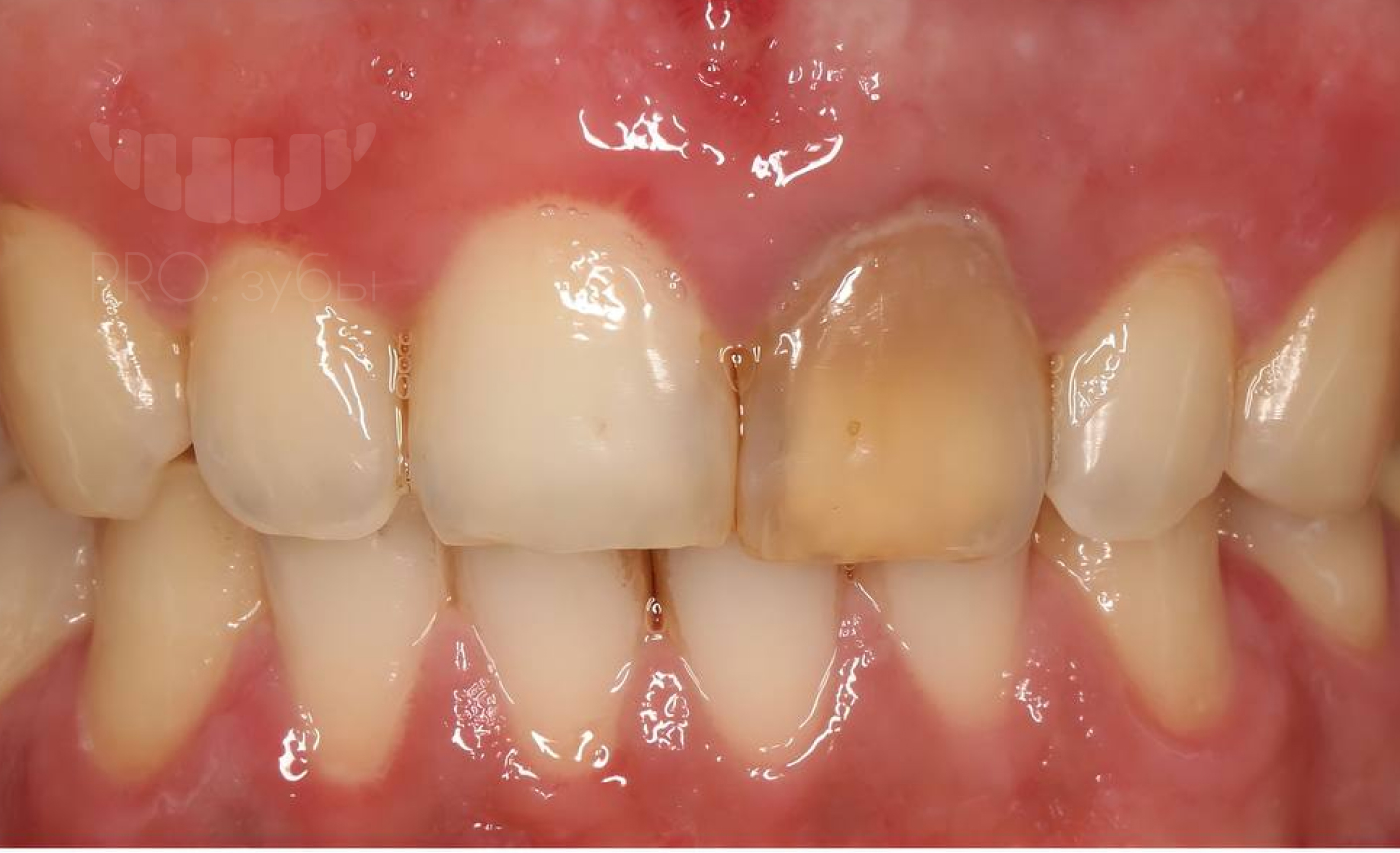 Внутриканальное отбеливание зуба. Центральный резец