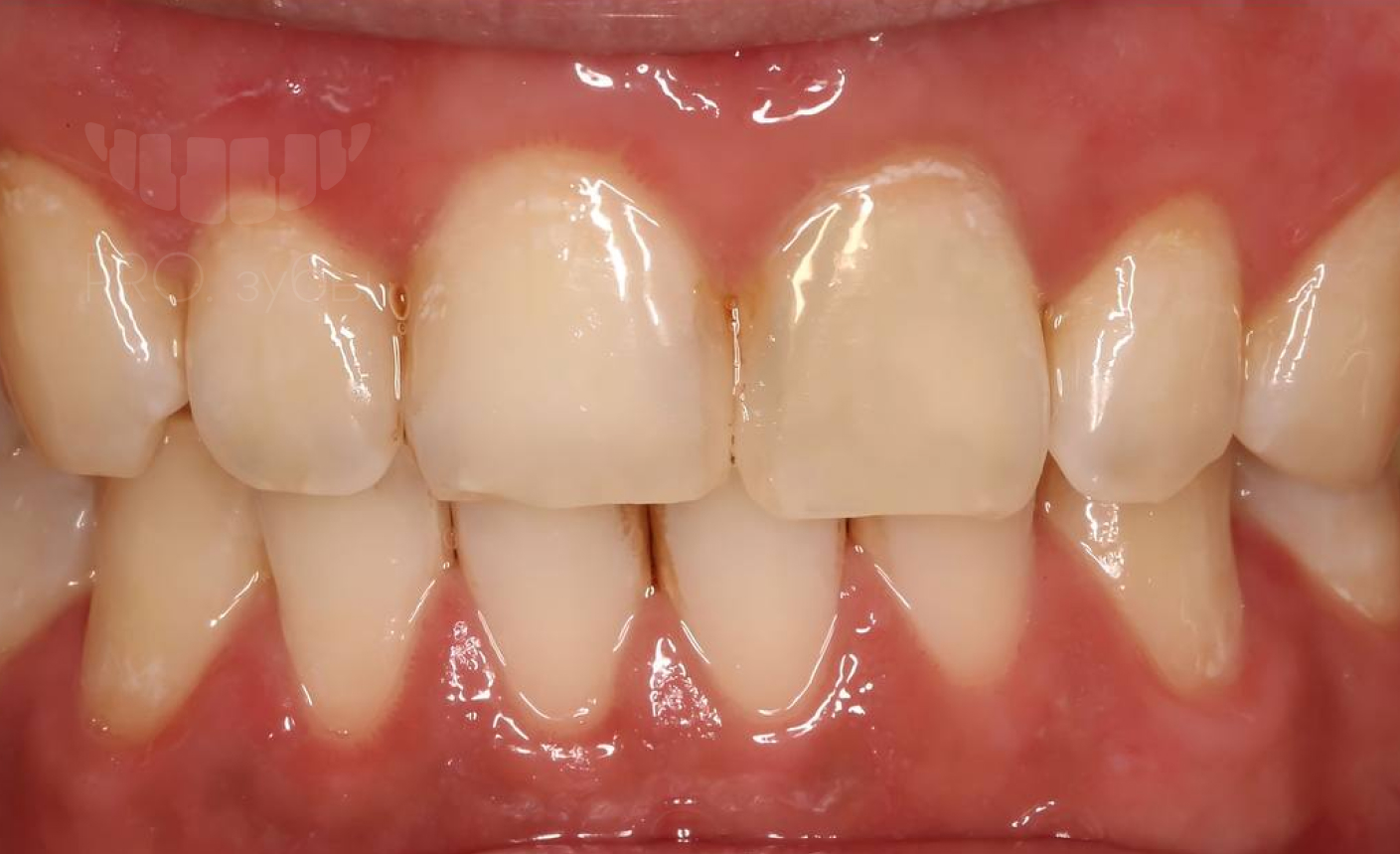 Внутриканальное отбеливание зуба. Центральный резец