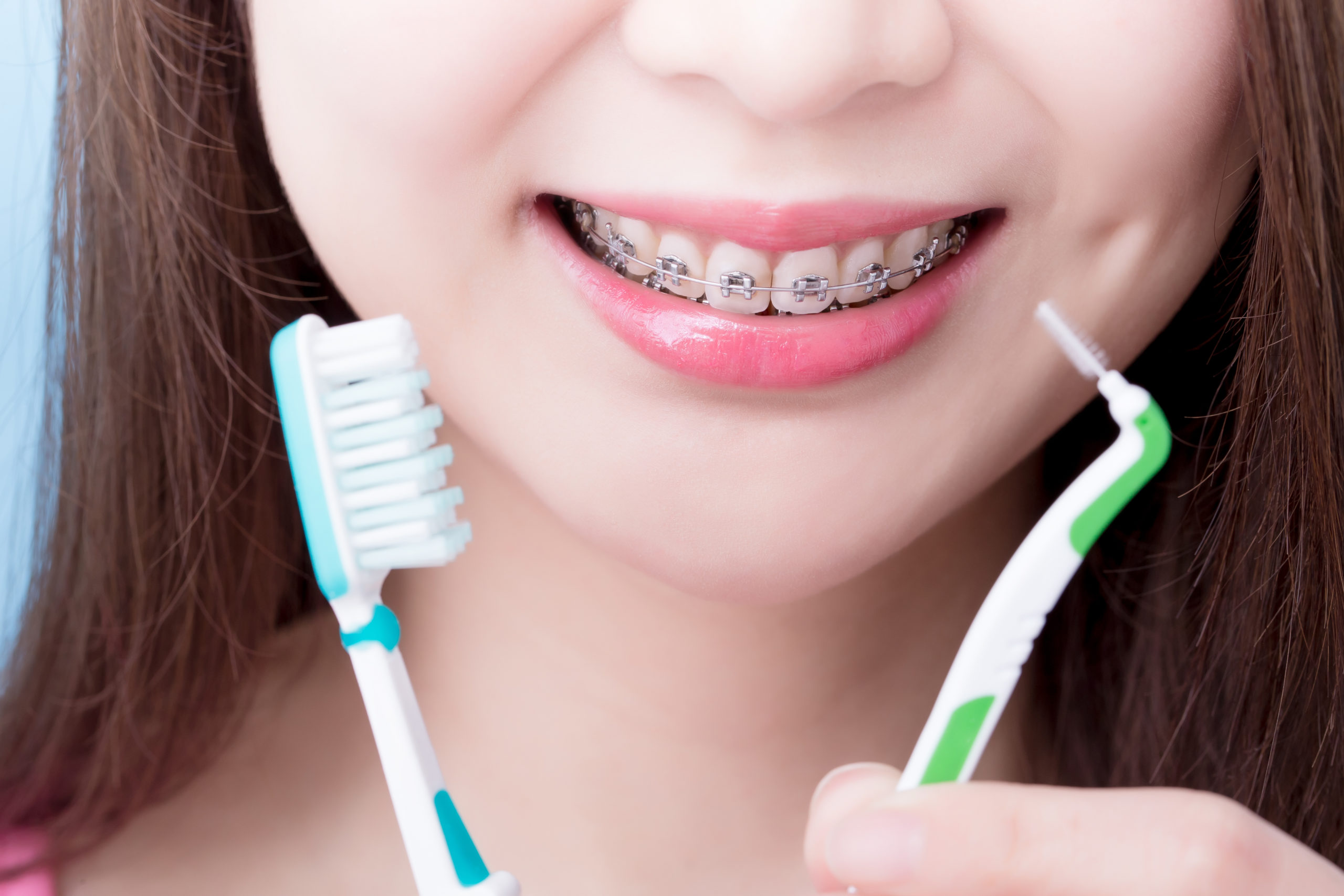 Как чистить зубы после установки брекетов?