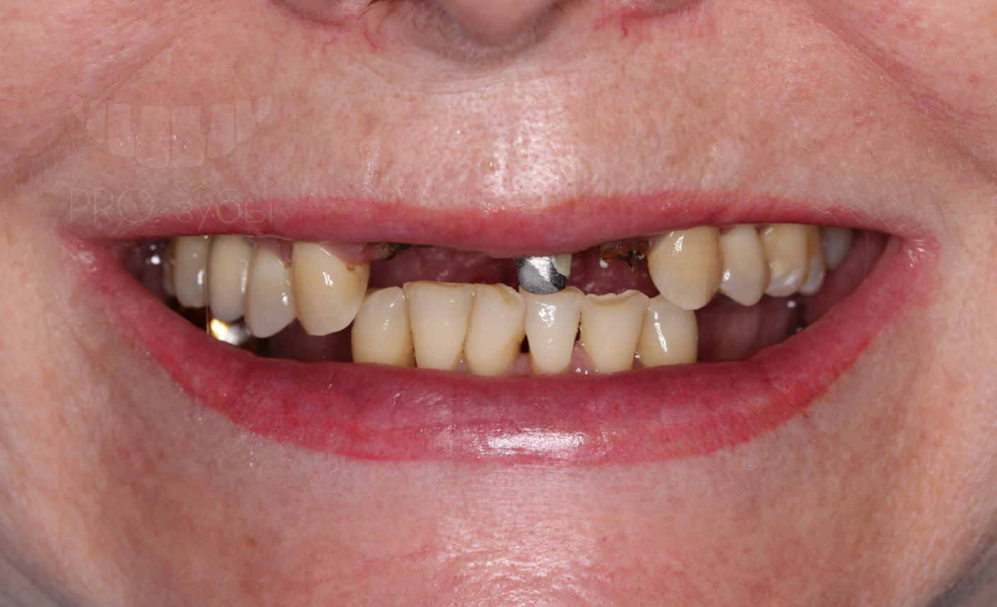 Удаление центральных зубов, имплантация, мостовидный протез на имплантатах