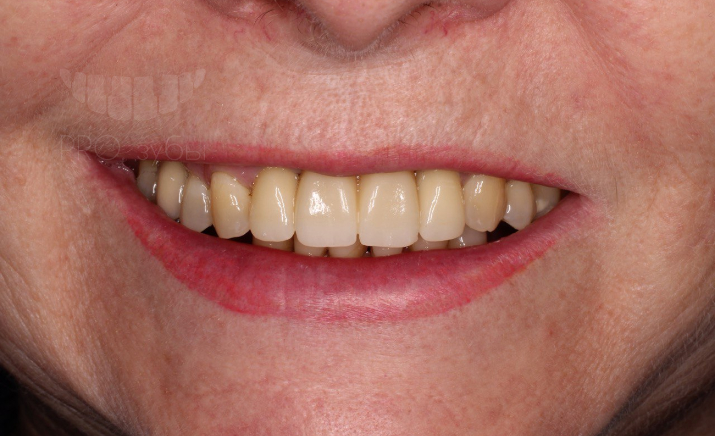 Удаление центральных зубов, имплантация, мостовидный протез на имплантатах